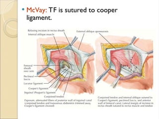  McVay: TF is sutured to cooper
ligament.
 