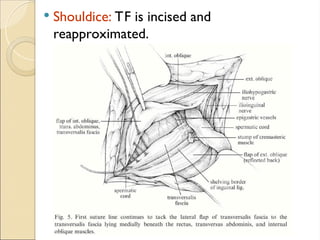  Shouldice: TF is incised and
reapproximated.
 