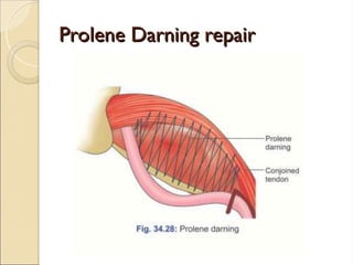 Prolene Darning repair
Prolene Darning repair
 