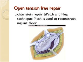 Open tension free repair
Open tension free repair
Lichtenstein repair &Patch and Plug
technique: Mesh is used to reconstruct
inguinal floor
 