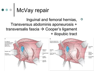 Mcvay Incision Hernia | PPT
