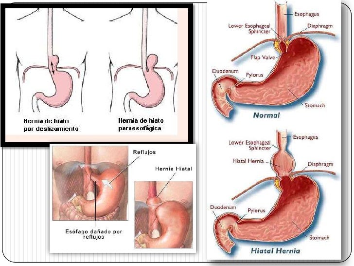 La osteocondrosis sheynogo del departamento de la columna vertebral la presión subida