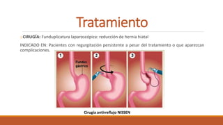 Tratamiento
oCIRUGÍA: Funduplicatura laparoscópica: reducción de hernia hiatal
INDICADO EN: Pacientes con regurgitación persistente a pesar del tratamiento o que aparezcan
complicaciones.
Cirugía antirreflujo NISSEN
 