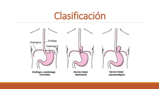 Clasificación
 