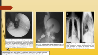 Radiografía PA y lateral de tórax.
Masa mediastínica posterior retrocardíaca con gran
nivel hidroaéreo y ausencia de burbuja gástrica
infradiafragmática izquierda. Hernia de hiato.
Stephen Lowry, MD, MBA Robert S. Dorian, MD, MBA. (2015). Schwartz Principios
de cirugía. México D.F.: McGraw-Hill Interamericana editores, S. A. de C.V.
 