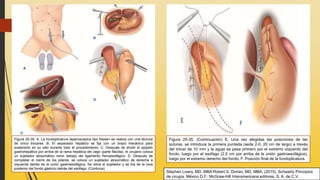 Figura 25-35. A. La fundoplicatura laparoscópica tipo Nissen se realiza con una técnica
de cinco trócares. B. El separador hepático se fija con un brazo mecánico para
sostenerlo en su sitio durante todo el procedimiento. C. Después de dividir el epiplón
gastrohepático por arriba de la rama hepática del vago (parte flácida), el cirujano coloca
un sujetador atraumático romo debajo del ligamento frenoesofágico. D. Después de
completar el cierre de los pilares, se coloca un sujetador atraumático de derecha a
izquierda detrás de la unión gastroesofágica. Se retira el sujetador y se tira de la cara
posterior del fondo gástrico detrás del esófago. (Continúa)
Figura 25-35. (Continuación) E. Una vez elegidas las posiciones de las
suturas, se introduce la primera puntada (seda 2-0, 20 cm de largo) a través
del trócar de 10 mm y la aguja se pasa primero por el extremo izquierdo del
fondo, luego por el esófago (2.5 cm por arriba de la unión gastroesofágica),
luego por el extremo derecho del fondo. F. Posición final de la fundoplicatura.
Stephen Lowry, MD, MBA Robert S. Dorian, MD, MBA. (2015). Schwartz Principios
de cirugía. México D.F.: McGraw-Hill Interamericana editores, S. A. de C.V.
 