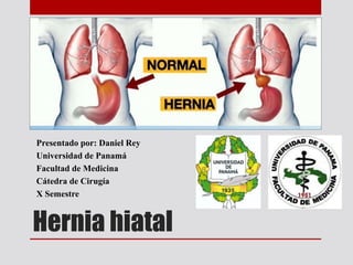 Hernia hiatal
Presentado por: Daniel Rey
Universidad de Panamá
Facultad de Medicina
Cátedra de Cirugía
X Semestre
 