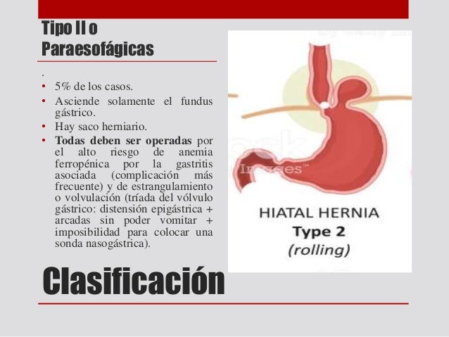 Hernia hiatal