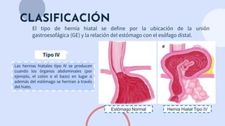 Tipo IV
CLASIFICACIÓN
El tipo de hernia hiatal se define por la ubicación de la unión
gastroesofágica (GE) y la relación del estómago con el esófago distal.
Las hernias hiatales tipo IV se producen
cuando los órganos abdominales (por
ejemplo, el colon o el bazo) en lugar o
además del estómago se hernian a través
del hiato.
Estómago Normal Hernia Hiatal Tipo IV
 