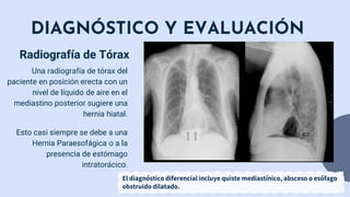 DIAGNÓSTICO Y EVALUACIÓN
Una radiografía de tórax del
paciente en posición erecta con un
nivel de líquido de aire en el
mediastino posterior sugiere una
hernia hiatal.
Esto casi siempre se debe a una
Hernia Paraesofágica o a la
presencia de estómago
intratorácico.
Radiografía de Tórax
El diagnóstico diferencial incluye quiste mediastínico, absceso o esófago
obstruido dilatado.
 