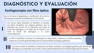 DIAGNÓSTICO Y EVALUACIÓN
Esofagoscopia con fibra óptica
La HPE se identifica al colocar el endoscopio en retroversión y observar un orificio separado,
adyacente a la unión gastroesofágica por el cual ascienden los pliegues gástricos.
Esta es útil para el diagnóstico y clasificación de la hernia
hiatal porque es posible retroflexionar el instrumento.
Una hernia mixta se identifica al encontrar una bolsa recubierta con pliegues gástricos por encima del
diafragma y al comprobar que la UGE se ubica aproximadamente a la mitad del largo total de la bolsa.
Una hernia hiatal deslizante se identifica al localizar
una bolsa recubierta con pliegues gástricos que se
extienden por encima de la impresión que causa el
borde del diafragma, o al medir por lo menos 2 cm
entre el borde del diafragma y la unión
escamocolumnar.
I
II
III
 