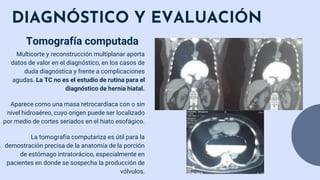 DIAGNÓSTICO Y EVALUACIÓN
Multicorte y reconstrucción multiplanar aporta
datos de valor en el diagnóstico, en los casos de
duda diagnóstica y frente a complicaciones
agudas. La TC no es el estudio de rutina para el
diagnóstico de hernia hiatal.
Aparece como una masa retrocardiaca con o sin
nivel hidroaéreo, cuyo origen puede ser localizado
por medio de cortes seriados en el hiato esofágico.
La tomografía computariza es útil para la
demostración precisa de la anatomía de la porción
de estómago intratorácico, especialmente en
pacientes en donde se sospecha la producción de
vólvulos.
Tomografía computada
 
