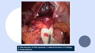 A: Pilar derecho. B: Pilar izquierdo. C: defecto herniario. D: Esófago.
E: Fondo Gástrico
 