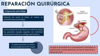 REPARACIÓN QUIRÚRGICA
4) Operación antirreflujo
Después de cerrar el hiato, se realiza un
procedimiento antirreflujo.
Una funduplicatura de Nissen se realiza en todos
los pacientes excepto aquellos con motilidad
severamente ineficaz o esófago aperistáltico.
En tales pacientes, se realiza
una funduplicatura de Toupet. Aunque la necesidad de un procedimiento antirreflujo es
controversial, muchos pacientes con hernia hiatal tienen
reflujo anormal.
 