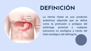 DEFINICIÓN
La Hernia Hiatal es una condición
anatómica adquirida que se define
como la protrusión o prolapso del
estómago proximal o cualquier
estructura no esofágica a través del
hiato esofágico del diafragma.
 