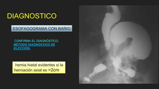 DIAGNOSTICO
CONFIRMA EL DIAGNÓSTICO.
MÉTODO DIAGNÓSTICO DE
ELECCIÓN.
hernia hiatal evidentes si la
herniación axial es >2cm
ESOFAGOGRAMA CON BARIO
 