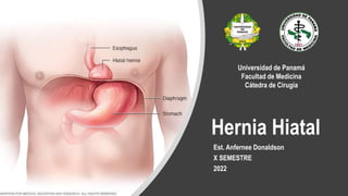 Hernia Hiatal
Est. Anfernee Donaldson
X SEMESTRE
2022
Universidad de Panamá
Facultad de Medicina
Cátedra de Cirugía
 