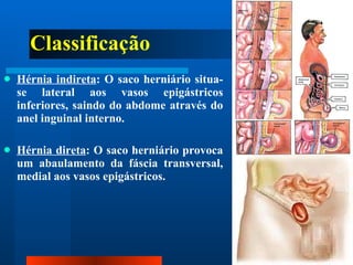 Classificação Hérnia indireta : O saco herniário situa-se lateral aos vasos epigástricos inferiores, saindo do abdome através do anel inguinal interno. Hérnia direta : O saco herniário provoca um abaulamento da fáscia transversal, medial aos vasos epigástricos. 