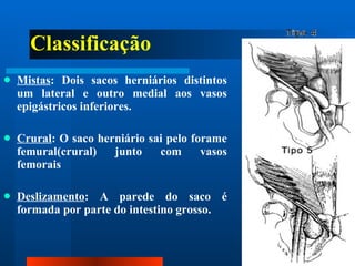 Classificação Mistas : Dois sacos herniários distintos um lateral e outro medial aos vasos epigástricos inferiores. Crural : O saco herniário sai pelo forame femural(crural) junto com vasos femorais Deslizamento : A parede do saco é formada por parte do intestino grosso. 