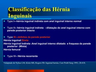 Classificação das Hérnia Inguinais Type I —hérnia inguinal indireta com anel inguinal interno normal Type II -- hérnia inguinal indireta  - dilatação do anel inguinal interno com parede posterior intacto Type  III—defeitos da parede posterior Hérnia inguinal  Direta Hérnia inguinal Indireta :Anel inguinal interno dilatado  e fraqueza da parede posterior  (Mista) Hérnia femural Type IV – Hérnia recorrente  Adaptade de Nyhus LM, Klein MS, Rogers FB.  Inguinal hernia. Curr Probl Surg 1991; 28:418.  