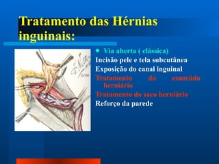 Tratamento das Hérnias inguinais: Via aberta ( clássica) Incisão pele e tela subcutânea Exposição do canal inguinal Tratamento do conteúdo herniário Tratamento do saco herniário Reforço da parede 