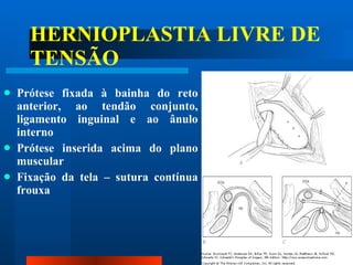 HERNIOPLASTIA LIVRE DE TENSÃO Prótese fixada à bainha do reto anterior, ao tendão conjunto, ligamento inguinal e ao ânulo interno Prótese inserida acima do plano muscular Fixação da tela – sutura contínua frouxa 