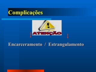 Complicações   Encarceramento  /  Estrangulamento 