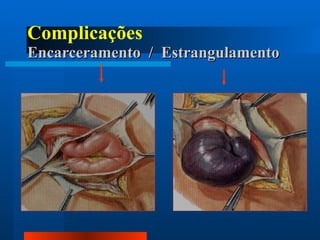 Complicações  Encarceramento  /  Estrangulamento 