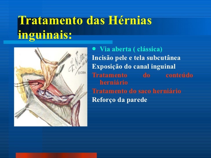 Hernia inguinais . dr. falcão Hernia inguinais . dr. falcão