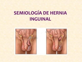 SEMIOLOGÍA DE HERNIA
      INGUINAL
 