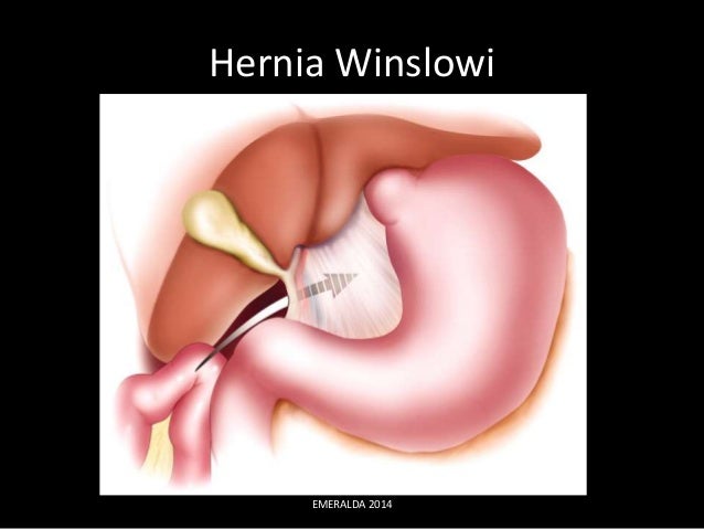Inguinal Hernia diagram of femoral hernia 