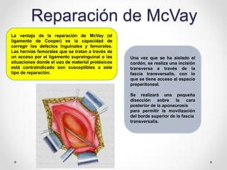 Mcvay Incision Hernia inguinal. | PPTX
