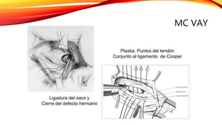 Mcvay Incision Hernia inguinal | PPTX