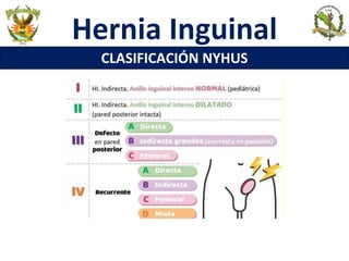 Hernia Inguinal
CLASIFICACIÓN NYHUS
 