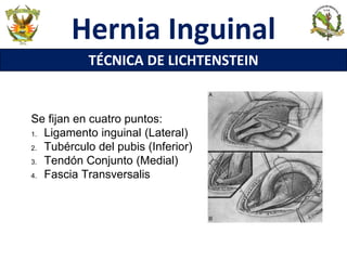 Se fijan en cuatro puntos:
1. Ligamento inguinal (Lateral)
2. Tubérculo del pubis (Inferior)
3. Tendón Conjunto (Medial)
4. Fascia Transversalis
Hernia Inguinal
TÉCNICA DE LICHTENSTEIN
 