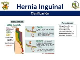 Hernia Inguinal
Clasificación
Por localización:
Por contenido:
Extraperitoneales (sin
sacoperitoneal),
paraperitoneales
(peritoneo adherido) e
intraperitoneales (saco
peritoneal completo)
 