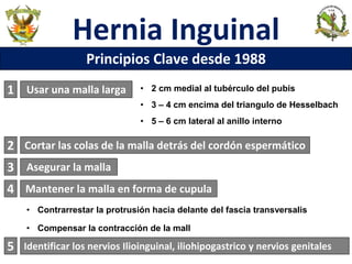 Hernia Inguinal
Principios Clave desde 1988
2
Usar una malla larga
1 • 2 cm medial al tubérculo del pubis
• 3 – 4 cm encima del triangulo de Hesselbach
• 5 – 6 cm lateral al anillo interno
Cortar las colas de la malla detrás del cordón espermático
3 Asegurar la malla
4 Mantener la malla en forma de cupula
• Contrarrestar la protrusión hacia delante del fascia transversalis
• Compensar la contracción de la mall
Identificar los nervios Ilioinguinal, iliohipogastrico y nervios genitales
5
 