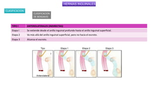 HERNIAS INGUINALES
CLASIFICACION
TIPO I ANTEROLATERALES (INDIRECTAS)
Etapa I Se extiende desde el anillo inguinal profundo hasta el anillo inguinal superficial.
Etapa 2 Va más allá del anillo inguinal superficial, pero no hacia el escroto.
Etapa 3 Alcanza el escroto.
CLASIFICACION
DE BENDAVID
 