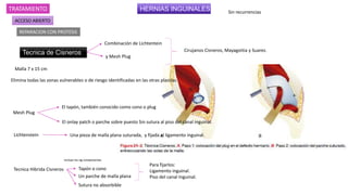 HERNIAS INGUINALES
TRATAMIENTO
ACCESO ABIERTO
REPARACION CON PROTESIS
Tecnica de Cisneros
Combinación de Lichtentein
y Mesh Plug
Cirujanos Cisneros, Mayagoitia y Suarez.
Elimina todas las zonas vulnerables o de riesgo identificadas en las otras plastias.
Mesh Plug
El tapón, también conocido como cono o plug
El onlay patch o parche sobre puesto Sin sutura al piso del canal inguinal.
Lichtenstein Una pieza de malla plana suturada, y fijada al ligamento inguinal.
Tecnica Hibrida Cisneros
Incluye los sig componentes
Tapón o cono
Un parche de malla plana
Sutura no absorbible
Para fijarlos:
Ligamento inguinal.
Piso del canal Inguinal.
Malla 7 x 15 cm
Sin recurrencias
 