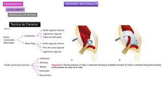 HERNIAS INGUINALES
TRATAMIENTO
ACCESO ABIERTO
REPARACION CON PROTESIS
Tecnica de Cisneros
Lichtentein
Mesh Plug
Zonas
vulnerables
detectadas Anillo inguinal interno
Piso del canal inguinal
Ligamento inguinal
Anillo inguinal interno
Ligamento inguinal
Tuberculo del pubis
Reforzar
Puede usarse para hernias:
Indirectas.
Directas.
Mixtas
Femorales
Recurrentes
 