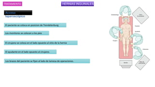 HERNIAS INGUINALES
Los brazos del paciente se fijan al lado de lamesa de operaciones.
Acceso
laparoscópico
TRATAMIENTO
El paciente se coloca en posicion de Trendelenburg
Los monitores se colocan a los pies
El cirujano se coloca en el lado opuesto al sitio de la hernia
El ayudante en el lado opuesto al cirujano.
 