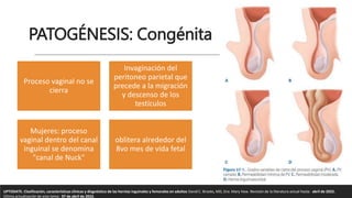 PATOGÉNESIS: Congénita
Proceso vaginal no se
cierra
Invaginación del
peritoneo parietal que
precede a la migración
y descenso de los
testículos
Mujeres: proceso
vaginal dentro del canal
inguinal se denomina
"canal de Nuck"
oblitera alrededor del
8vo mes de vida fetal
UPTODATE. Clasificación, características clínicas y diagnóstico de las hernias inguinales y femorales en adultos David C. Brooks, MD, Dra. Mary Haw. Revisión de la literatura actual hasta: abril de 2022.
Última actualización de este tema: 07 de abril de 2022.
 
