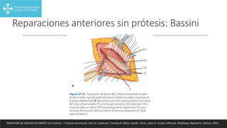 Reparaciones anteriores sin prótesis: Bassini
PRINCIPIOS DE CIRUGIA SCHWARTZ 10.ª Edición. F. Charles Brunicardi, Dana K. Andersen, Timothy R. Billiar, David L. Dunn, John G. Hunter, Jeffrey B. Matthews, Raphael E. Pollock. 2015
 