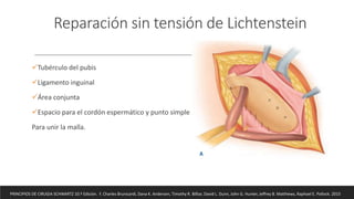 Reparación sin tensión de Lichtenstein
Tubérculo del pubis
Ligamento inguinal
Área conjunta
Espacio para el cordón espermático y punto simple
Para unir la malla.
PRINCIPIOS DE CIRUGIA SCHWARTZ 10.ª Edición. F. Charles Brunicardi, Dana K. Andersen, Timothy R. Billiar, David L. Dunn, John G. Hunter, Jeffrey B. Matthews, Raphael E. Pollock. 2015
 