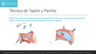 Técnica de Tapón y Parche
Gilbert desarrolló una modificación de la reparación de Lichtenstein, conocida como técnica de
tapón y parche que más tarde fue apoyada por Rutkow y Robbins.
PRINCIPIOS DE CIRUGIA SCHWARTZ 10.ª Edición. F. Charles Brunicardi, Dana K. Andersen, Timothy R. Billiar, David L. Dunn, John G. Hunter, Jeffrey B. Matthews, Raphael E. Pollock. 2015
 