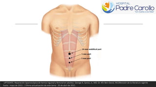 UPTODATE. Reparación laparoscópica de hernia inguinal y femoral en adultos. George A. Sarosi, Jr., MD. Dr. Kfir Ben-David, FACSRevisión de la literatura vigente
hasta: mayo de 2022. | Última actualización de este tema: 29 de abril de 2021.
 