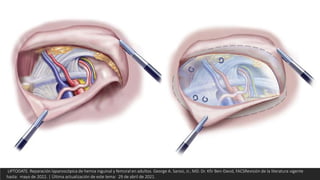 UPTODATE. Reparación laparoscópica de hernia inguinal y femoral en adultos. George A. Sarosi, Jr., MD. Dr. Kfir Ben-David, FACSRevisión de la literatura vigente
hasta: mayo de 2022. | Última actualización de este tema: 29 de abril de 2021.
 
