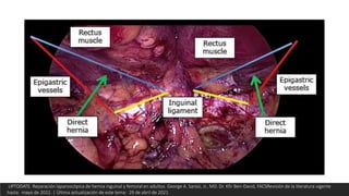 UPTODATE. Reparación laparoscópica de hernia inguinal y femoral en adultos. George A. Sarosi, Jr., MD. Dr. Kfir Ben-David, FACSRevisión de la literatura vigente
hasta: mayo de 2022. | Última actualización de este tema: 29 de abril de 2021.
 