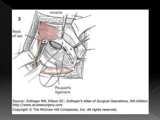 Hernia inguinal con tension