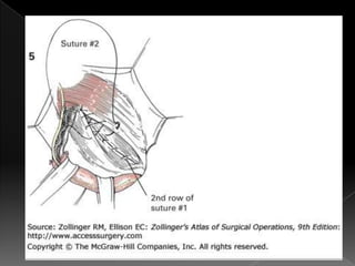Hernia inguinal con tension